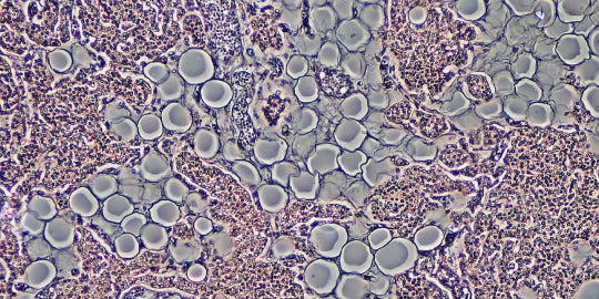 660 Bone marrow coagulated and low-level laser therapy accelerate bone healing