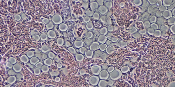 660 Bone marrow coagulated and low-level laser therapy accelerate bone healing