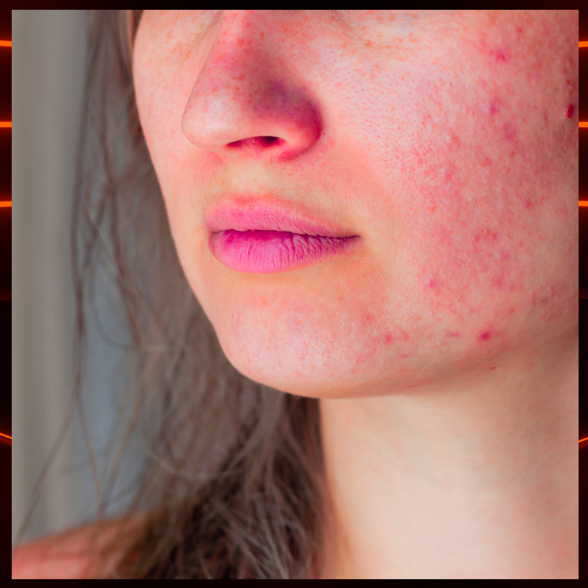 Close-up of woman with melasma on cheeks representing facial hyperpigmentation concerns