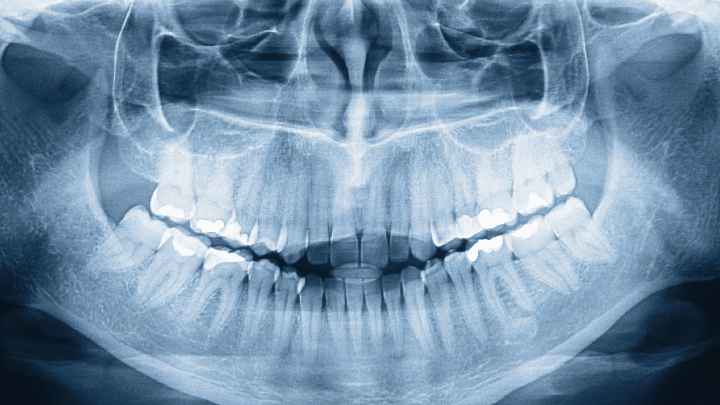Dentin Hypersensitivity Relief: A Systematic Review and Meta-Analysis - Lumaflex