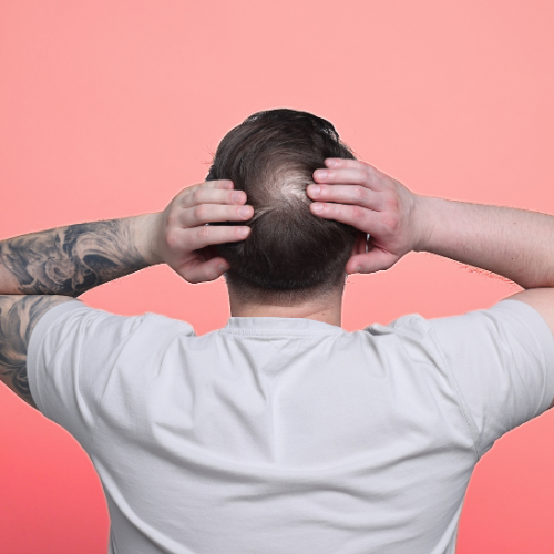 Red light therapy and bald spots