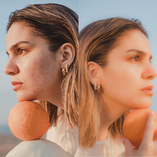 red light therapy for acne scars