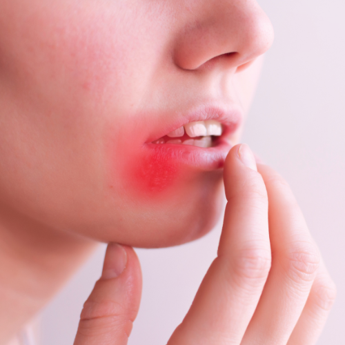Woman with a cold sore on her lip, representing how cold sore scars can form and heal over time
